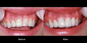Porcelain Crowns Case Study