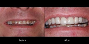 Implants & Crowns
