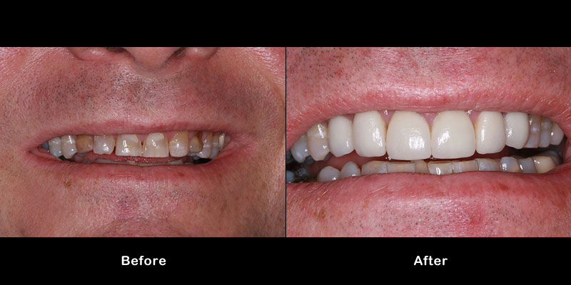 Implants & Crowns